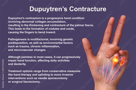A 3D medical illustration displaying a patient's hand with Dupuytren's ...