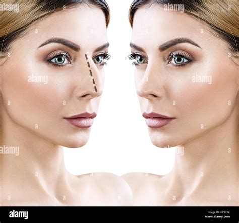 Female nose before and after cosmetic surgery Stock Photo - Alamy