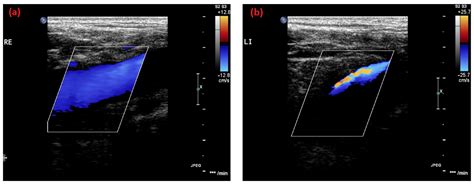 Familiar Disposition of May–Thurner Syndrome—A Case Series