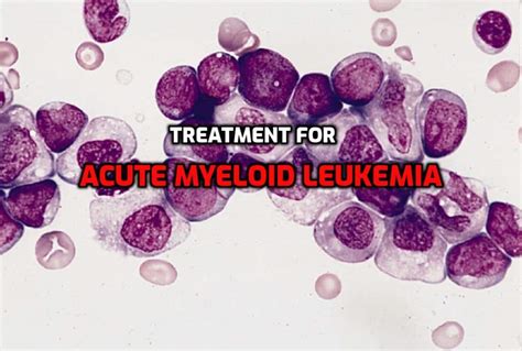 Acute myeloid leukemia: This drug combination can cure this condition ...
