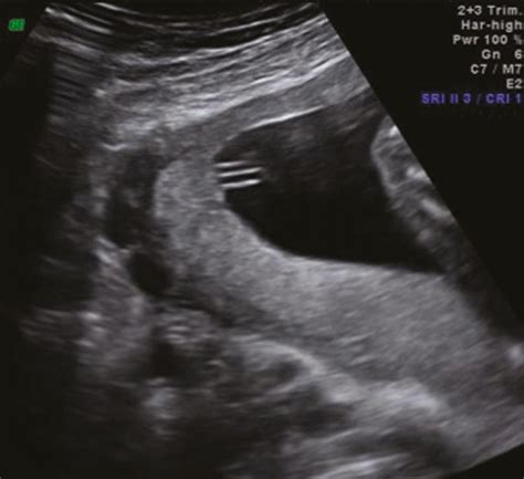 Placenta and Umbilical Cord Imaging - Clinical Tree