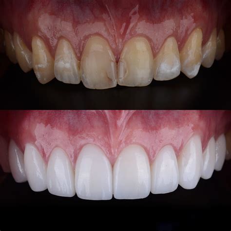 Cosmetic Veneers in Glendale, AZ | Smile Science Dental Spa