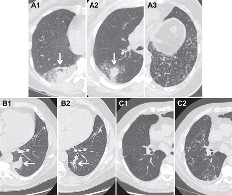 ACR Lung-RADS v2022: Assessment Categories and Management Recommendations - Journal of the ...