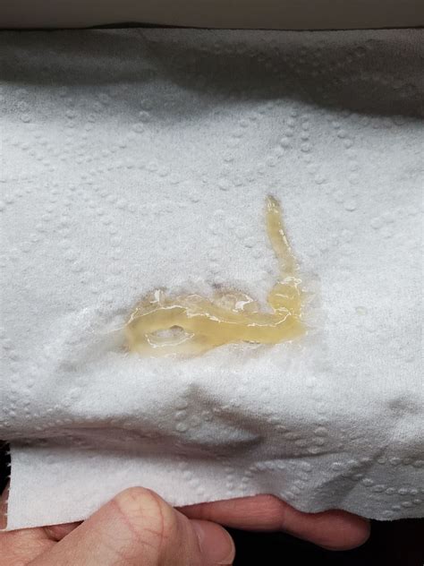 Clear Gelatinous Discharge | BabyCenter