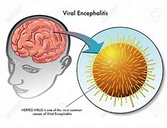 encephalitis 的图像结果