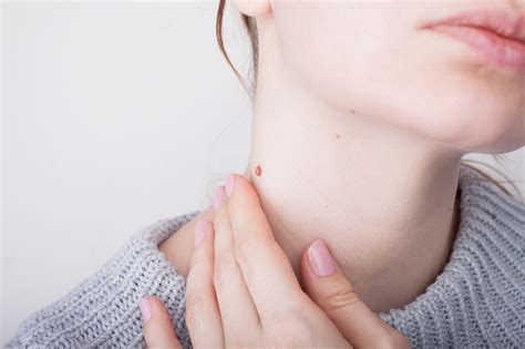 Skin Tag Removal On Neck | Remove Neck Skin Tags