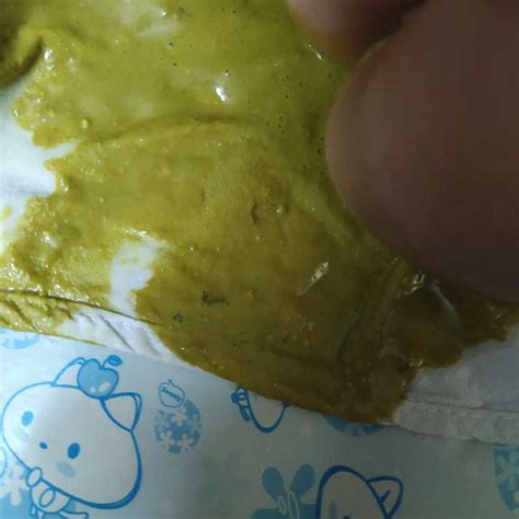 Pinworms In Baby Stool