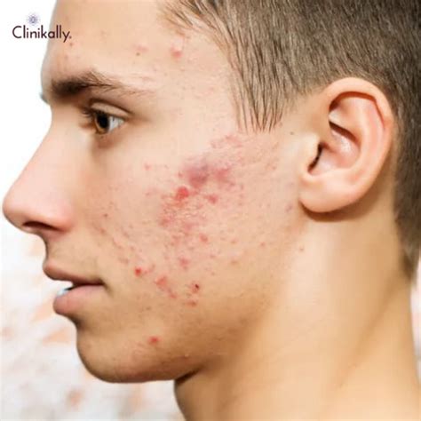 The Truth About Junk Food and Acne | Clinikally