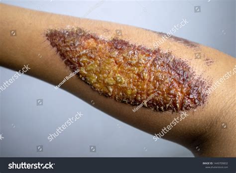 36 Skin Abrasion Healing Process Images, Stock Photos & Vectors | Shutterstock
