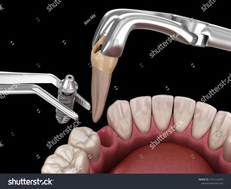 Image result for Tooth Extraction Surgery