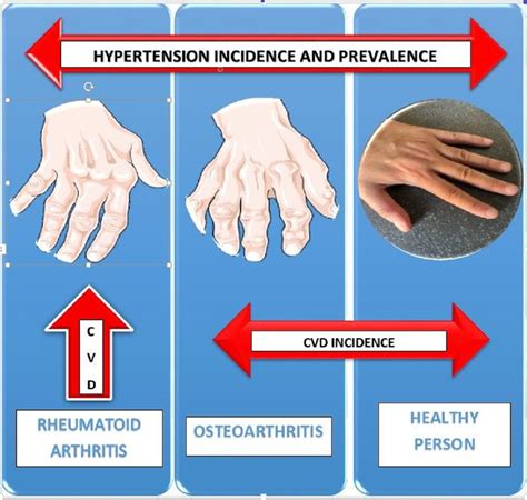 The Influence of Rheumatoid Arthritis and Osteoarthritis on the Occurrence of Arterial ...