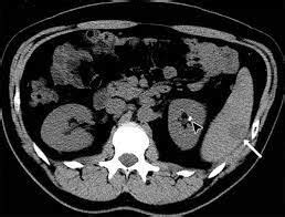 Partial splenectomy preserves splenic function for benign lesions in ...