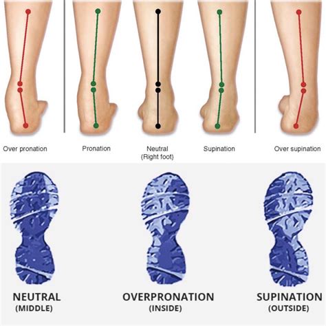 Overpronation Of Foot
