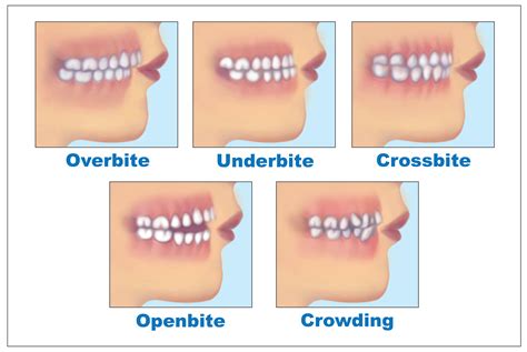 ORTHODONTICS - Modern Dental Clinic, Calicut