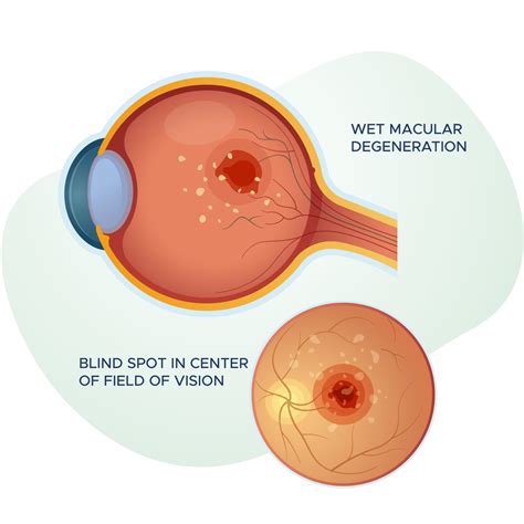 Macular Degeneration Treatment Macular Degeneration (AMD) Causes And