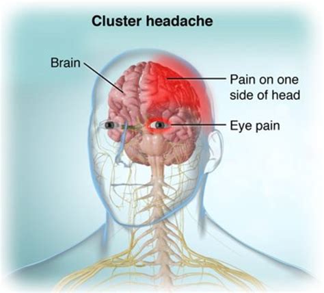 Cluster Headache Characteristics - YouMeMindBody