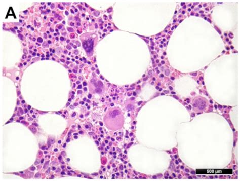 Cancers | Special Issue : Pathogenesis and Natural History of ...