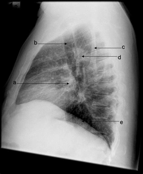 Chest X Ray Lateral View Anatomy at Jerry Fifield blog