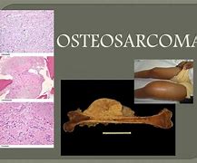 Osteosarcoma 的图像结果