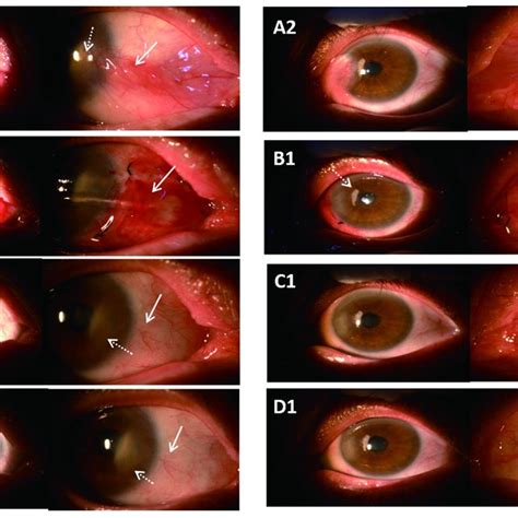 Subconjunctival Injection 的图像结果