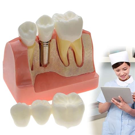 Buy 4 Times Dental Im Teeth Crown Bridge Demonstration Model ...