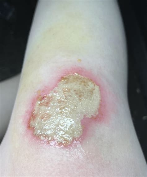 Is this cut infected? : r/woundcare