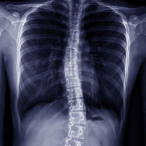 Understanding Scoliosis: Key Insights for Scoliosis Awareness Month ...
