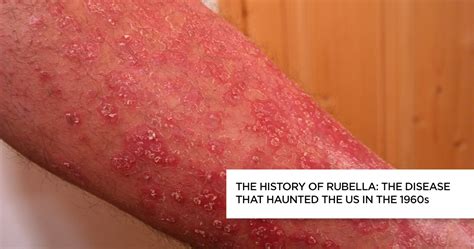 Bildergebnis für rubella symptoms