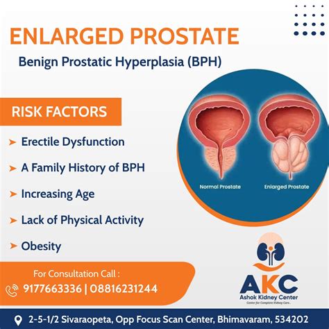 Understanding The Primary Risk Factors For Bph: A Complete Guide