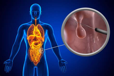 Image result for Polypectomy Recovery