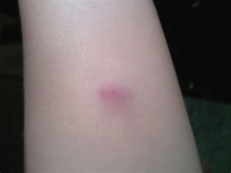 What Does A Negative Skin Tb Test Look Like at Shawn Cummings blog