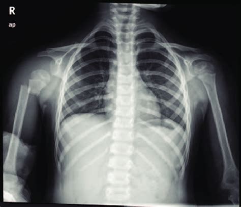 Image result for Normal Shoulder Alignment