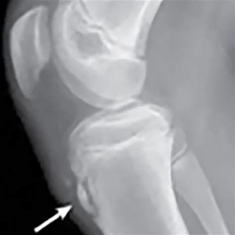 Osgood Schlatter Disease X Ray