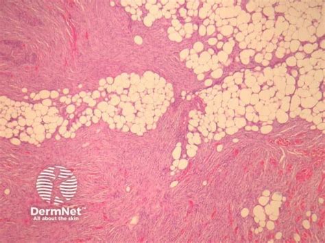 Image result for Dermatofibrosarcoma Protuberans