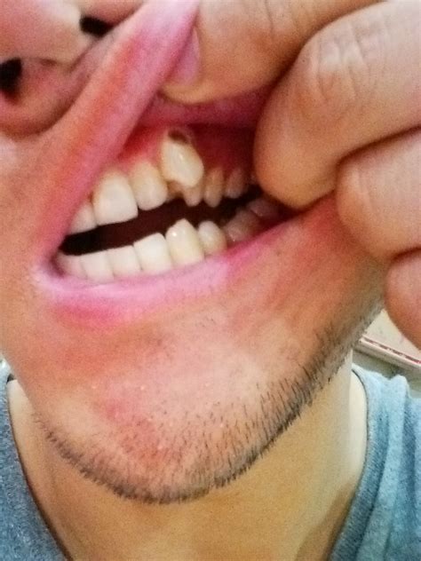 虎牙龋洞，现在补上了，用指甲刮牙龈边上牙齿的时候能刮到牙齿和补牙材料的断层，有必要注意吗，正常吗_百度知道