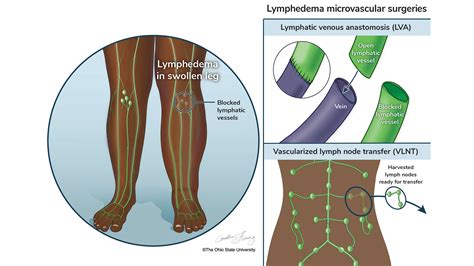 Advancing breast cancer and lymphedema outcomes | Ohio State Health & Discovery