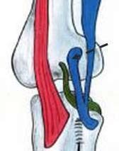 Lateral Collateral Ligament (LCL) treatment | DR. RAJ KANNA