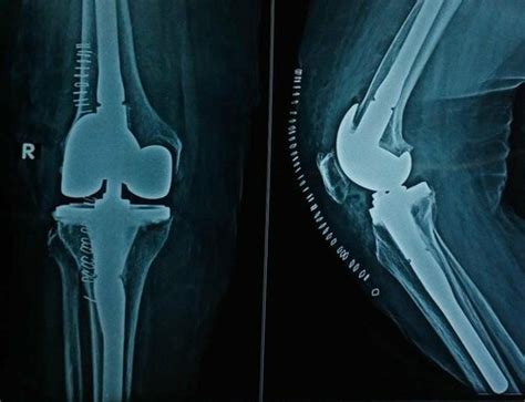A challenging valgus OA knee for knee replacement. Dr Kiran Kharat ...