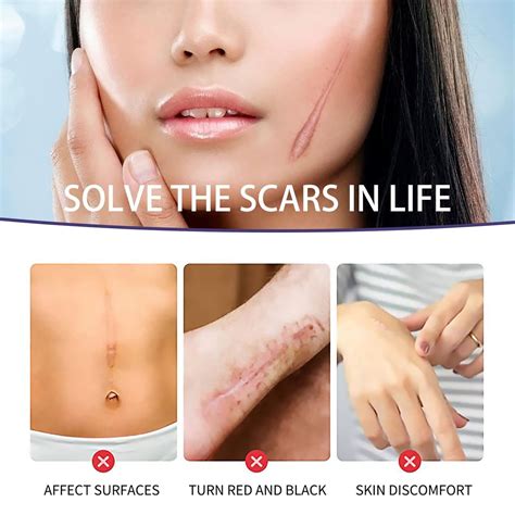 Buy Scar Away Silicone Scar Sheets (1.6” x 59”) Professional Reusable ...