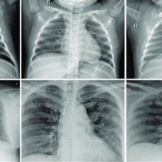 Image result for Normal X-ray