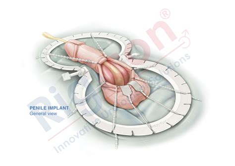 Infla10® Pulse™ Series - Inflatable Penile Prosthesis