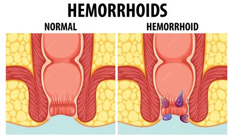 Can Hemorrhoids Burst