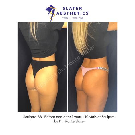 Sculptra Butt Lift