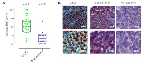 Oncogenic Role of an Epigenetic Reader of m6A RNA Modification: YTHDF1 ...