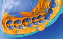 Silagum Light: Flowable viscosity for easy application