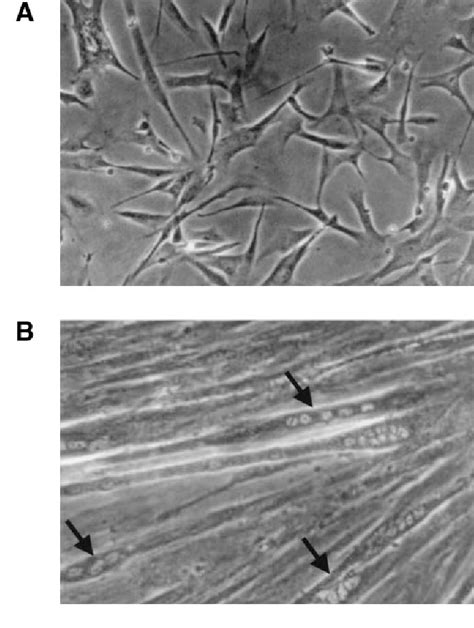 Image result for Pyruvate Dehydrogenase Complex Deficiency