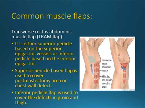 Flaps in surgery | PPTX