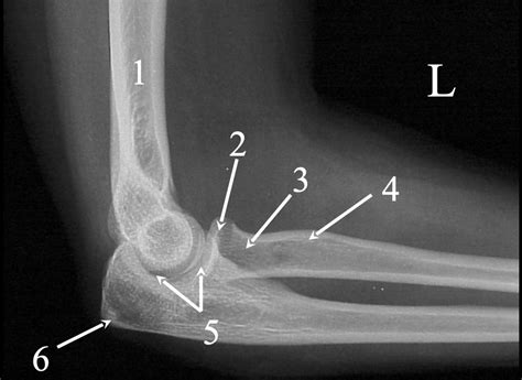 Image result for Elbow Contralateral