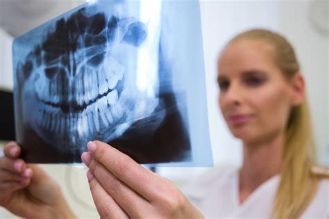 Does Bone Density Affect Dental Implants at Barbara Sant blog