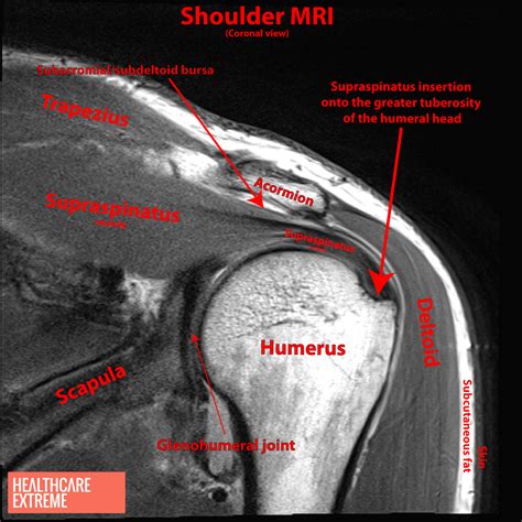 Subdeltoid Bursitis